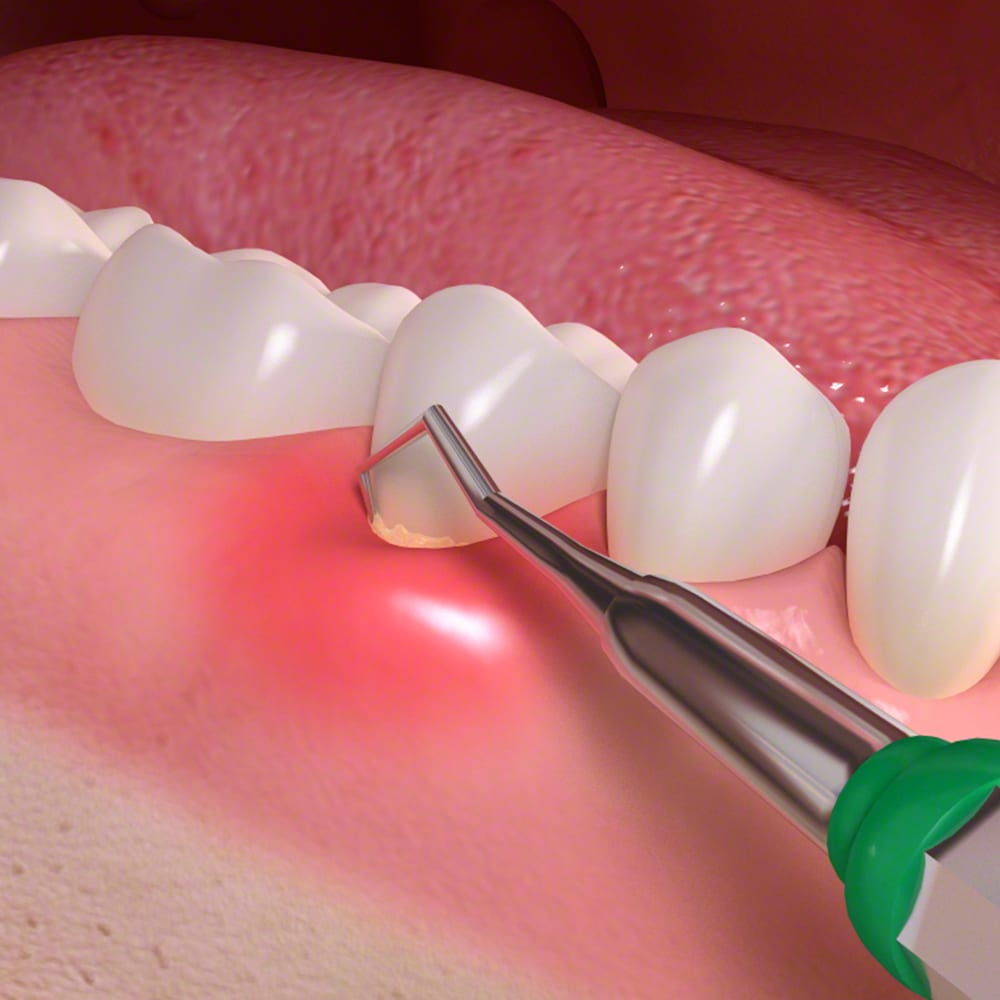 Parodontologie Therapie Zahnfleischerkrankung